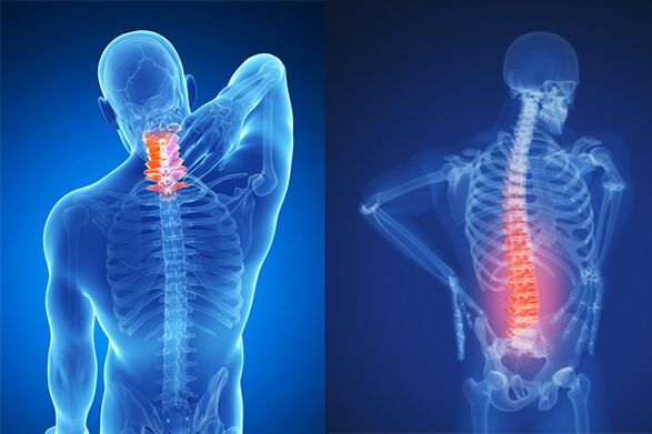 Արգանդի վզիկի և գոտկային ողնաշարի օստեոխոնդրոզ