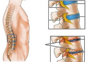 Lumbar- ի օստեոխոնդրոսի պատճառները