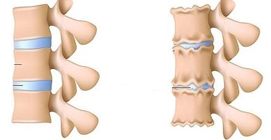 Ինչպես ճանաչել Lumbar- ի օստեոխոնդրոսի առկայությունը